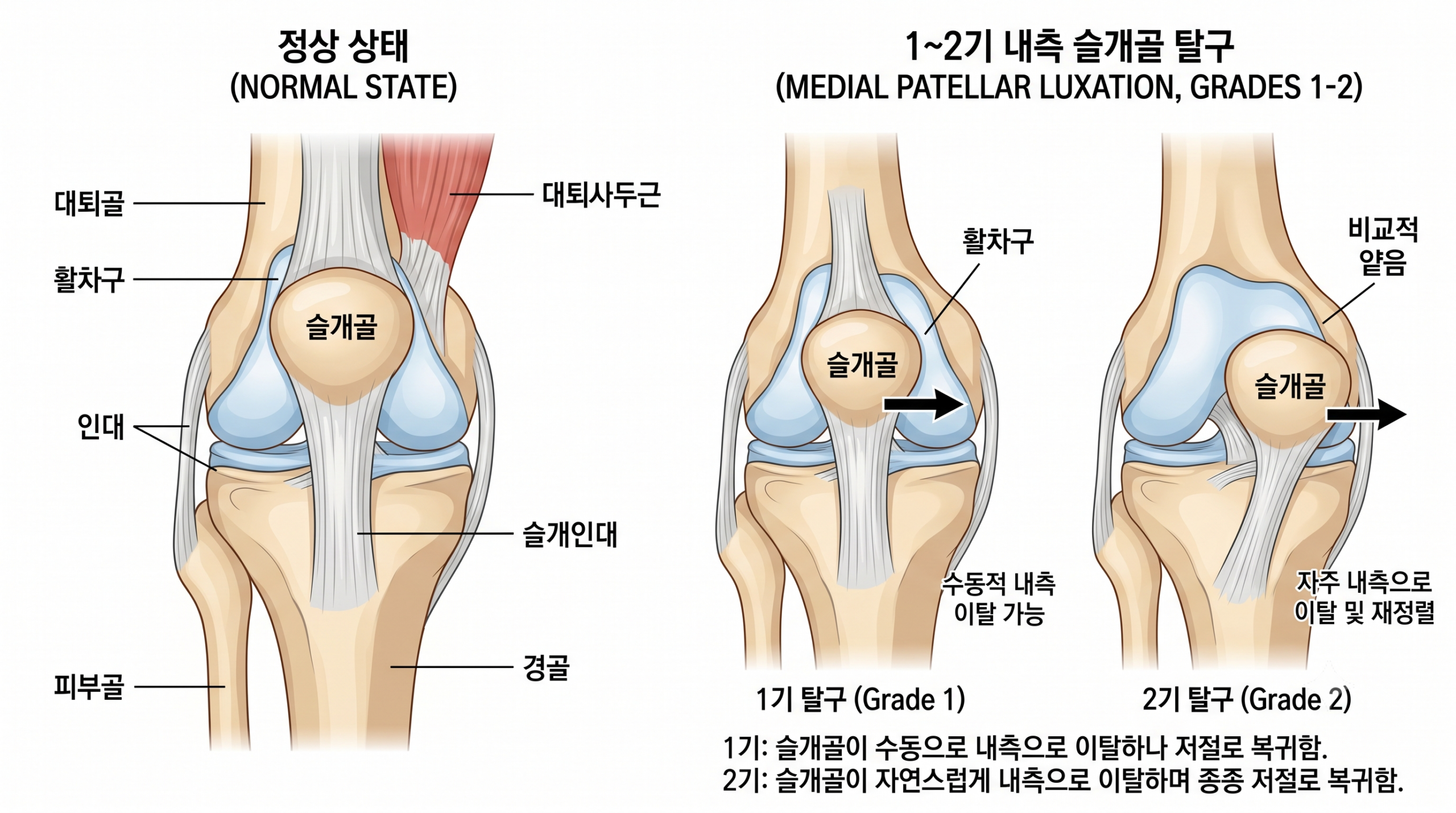 강아지 슬개골탈구 해부학 구조 — 정상과 탈구 비교